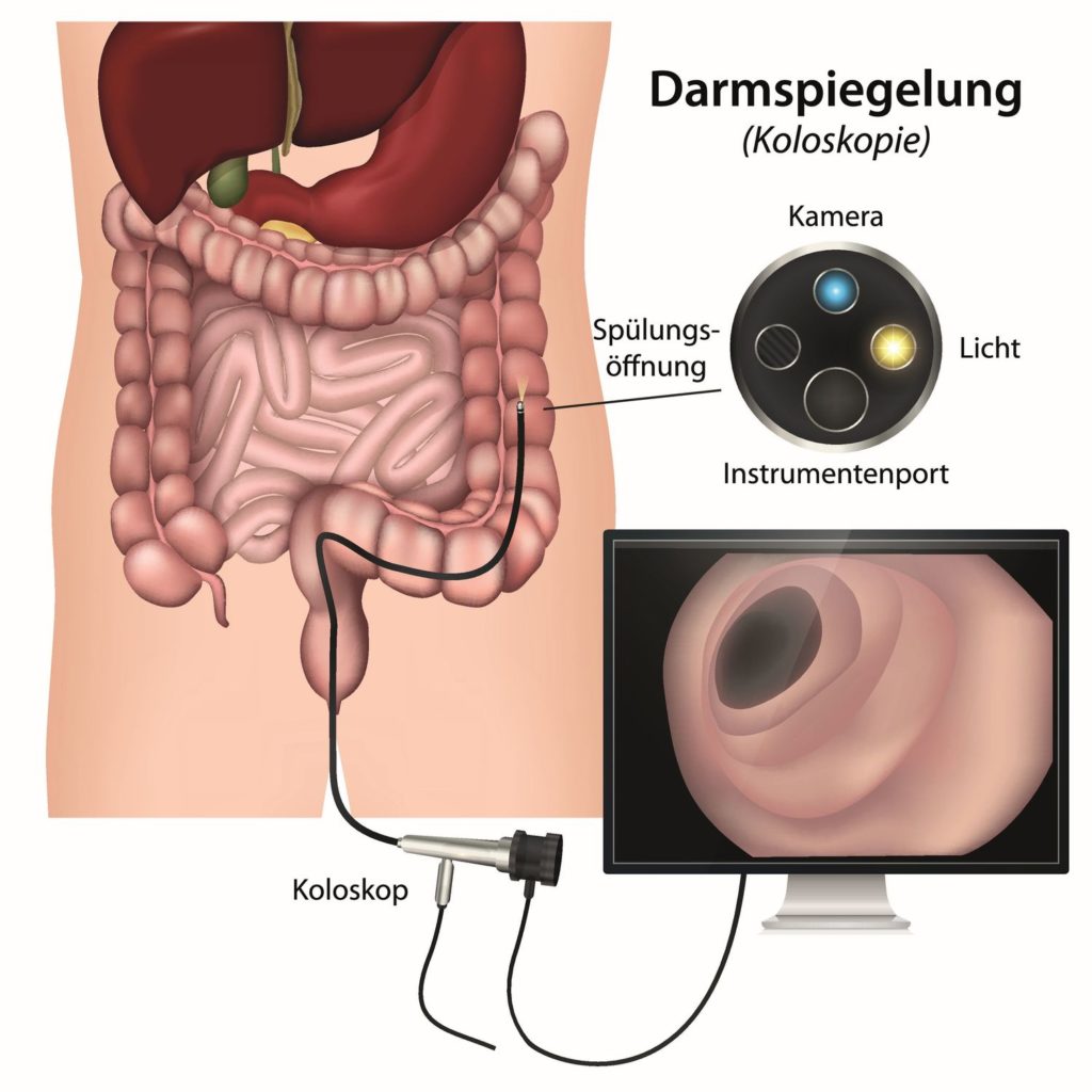 Darmspiegelung, Koloskopie