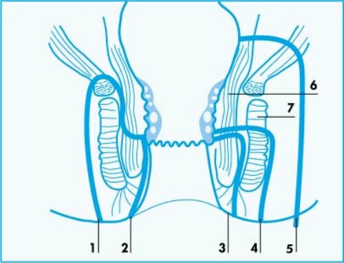 Analfistel und Analabszeß