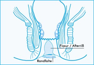 proktologiepraxis-frankfurt-analtfissur