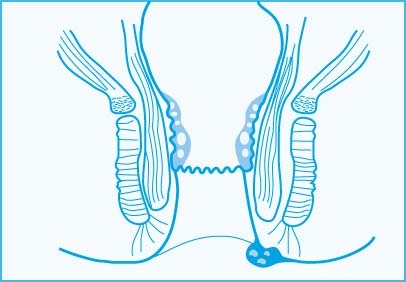 proktologiepraxis-frankfurt-analthrombosen