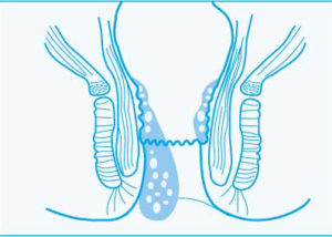 proktologiepraxis-frankfurt-haemorrhoidenKnoten
