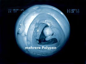 proktologiepraxis-frankfurt-mehrePolypen
