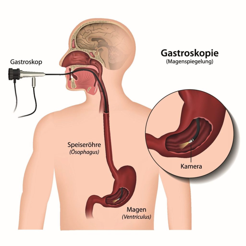Gastroskopie, Magenspiegelung