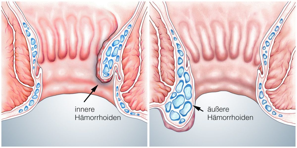 Hämorrhoiden Überörtliche Berufsausübungsgemeinschaft Saad/Gilbert